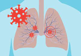 Here's the Damage Coronavirus (COVID-19) Can Do to Your Lungs – Health  Essentials from Cleveland Clinic